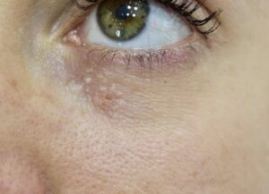 Grains de milium, petits kystes de kératine qui se forment souvent au niveau du visage et atour des yeux. Ils peuvent être traités sans cicatrice par plasma à froid (PlexR)