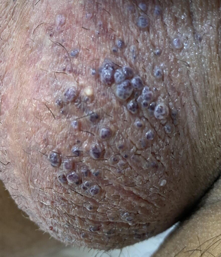 Angiokératomes du scrotum, petites papules surélevées rouges violettes avant traitement par laser vasculaire Nd-YAG et PlexR