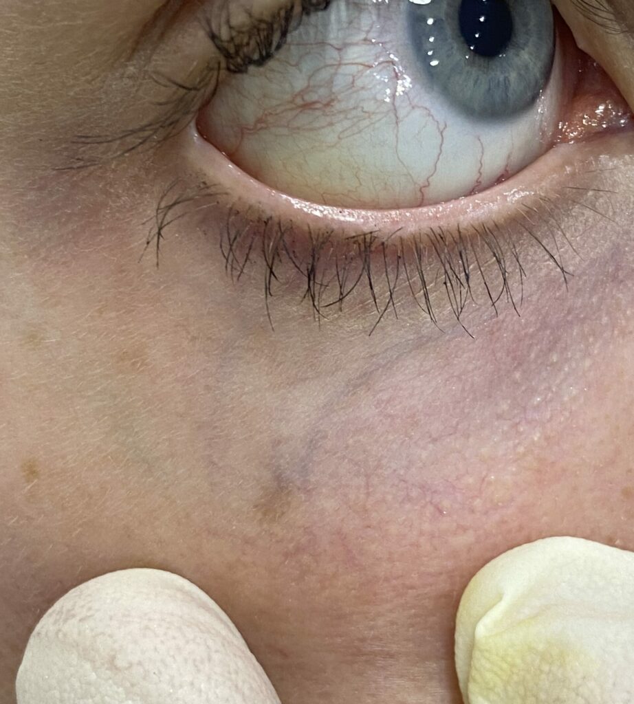 Veines périorbitaires externes, responsables de petites poches sous les yeux avec un traitement par laser vasculaire YAG.