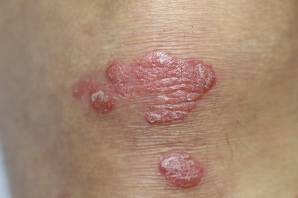 Psoriasis du genou, avant traitement par laser à colorant pulsé (laser vasculaire) ce qui permet d'obtenir une diminution importante de la composition inflammatoire.