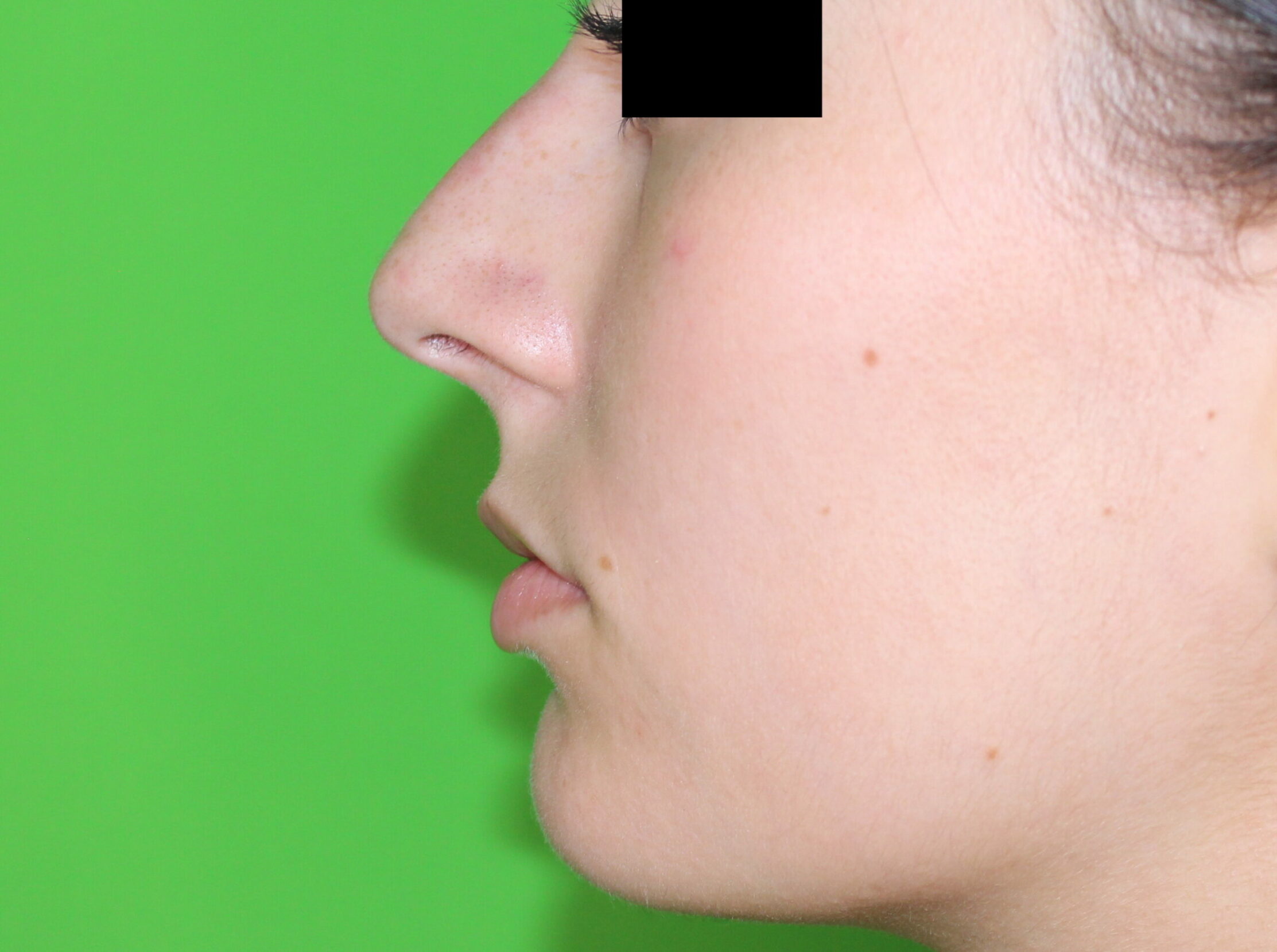 Rhinoplastie médicale par injection d'acide hyaluronique sans chirurgie - Juste après l'intervention