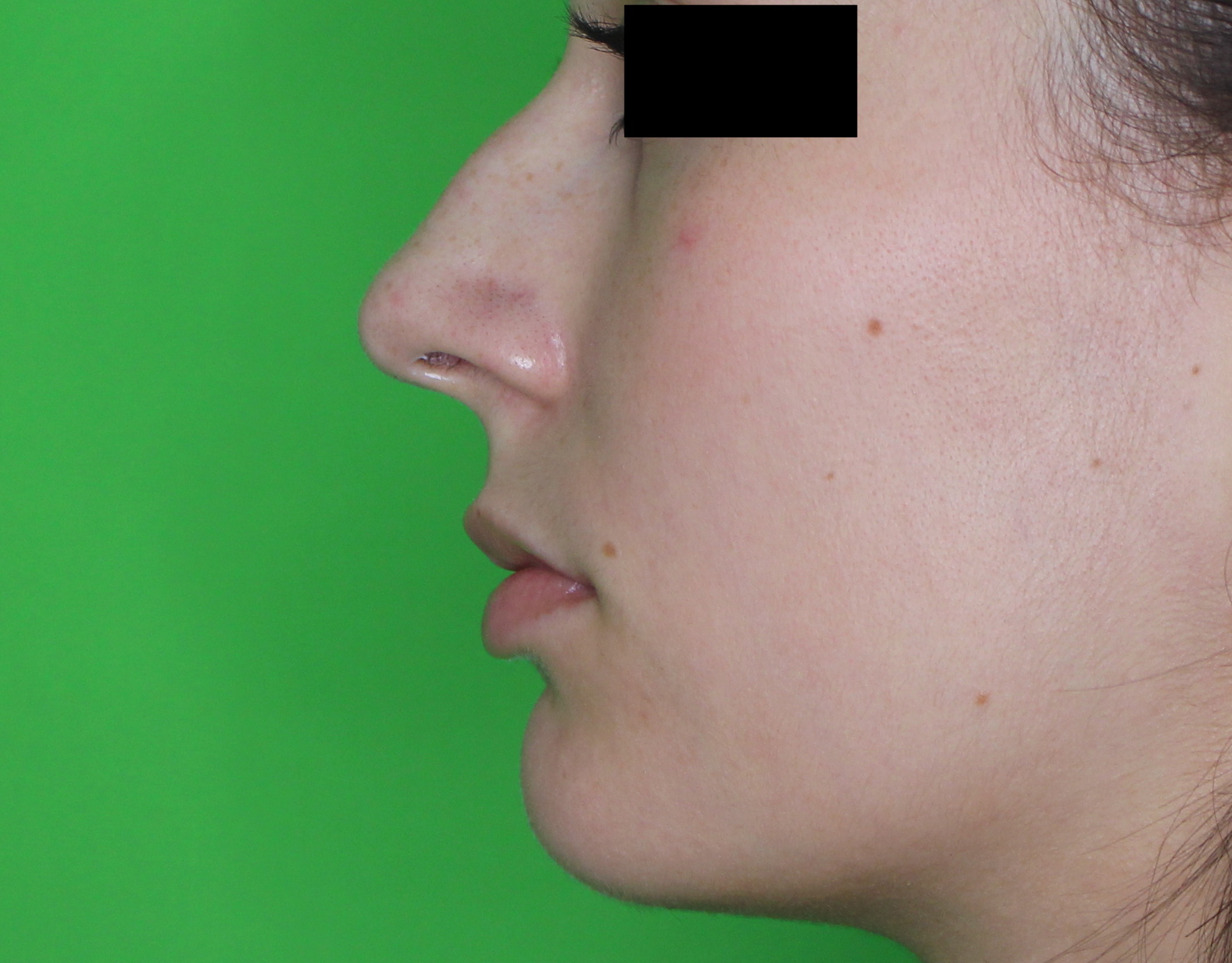 Rhinoplastie médicale par injection d'acide hyaluronique sans chirurgie - Avant intervention