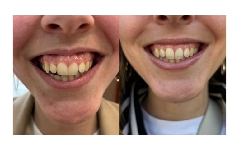 Traitement du sourire gingival par injection (photo avant et après)